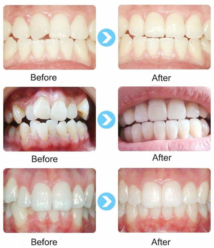 Teeth alignment outlet