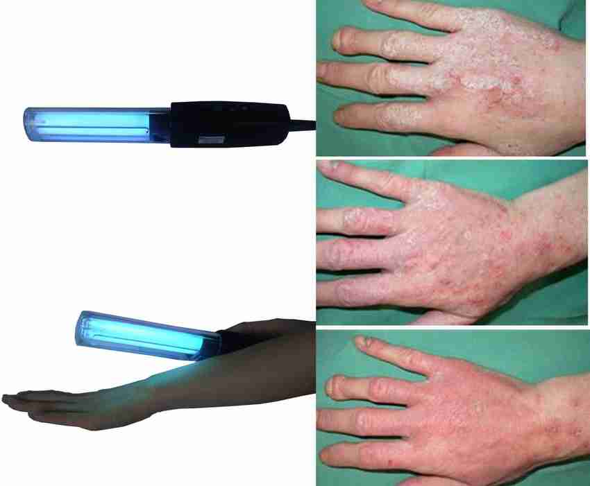 Diklap NBUVB Phototherapy Lamp for Treatment of Vitiligo, Psoriasis and Skin Disorder (Home-use ; UV 5 Star Rating) Hands Puva Therapy with UV Rays Eye Protection Goggles UV Sterilization Stick Price in India - Buy Diklap NBUVB Phototherapy Lamp for Treatment of Vitiligo, Psoriasis and Skin Disorder (Home-use ; UV 5 Star Rating) Hands Puva Therapy with UV Rays Eye Protection Goggles UV Sterilization Stick online at Flipkart.com