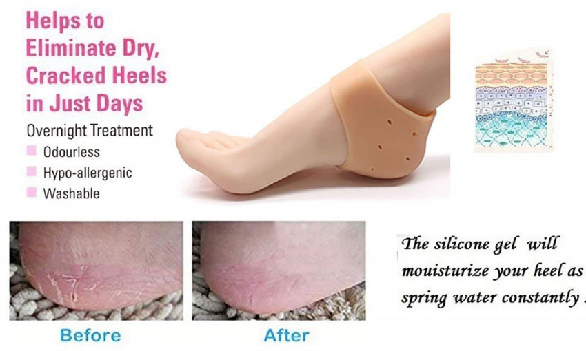 Hard sales heels treatment