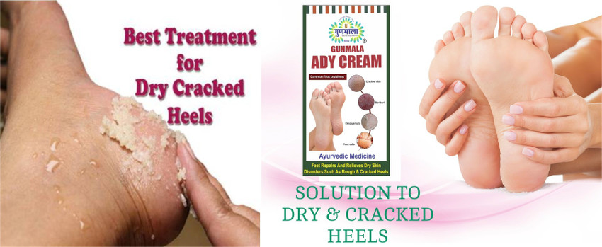 Gunmala ayurvedic ady cream for healing and soothing of heels