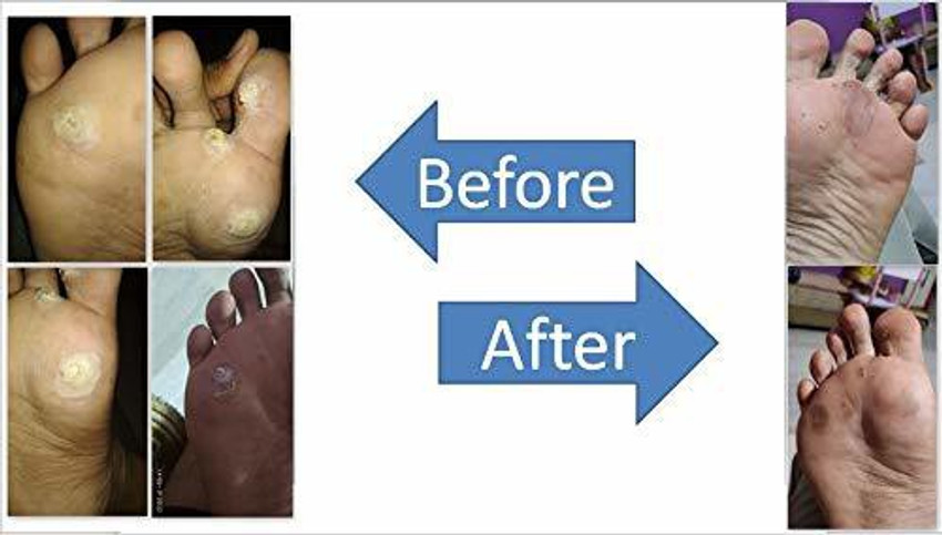 Laxminarayan Ayurvedic Foot Corn Remover Hand Corn Remover