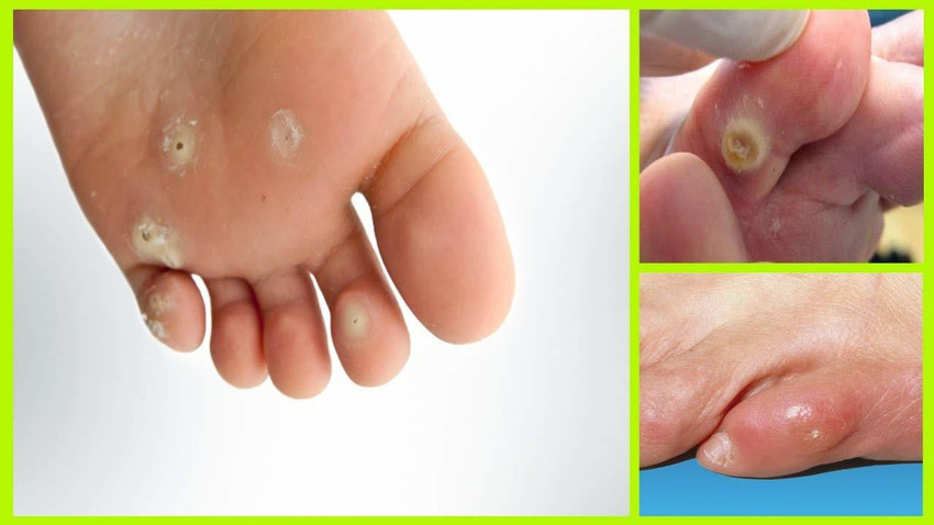 Corns on store foot in telugu