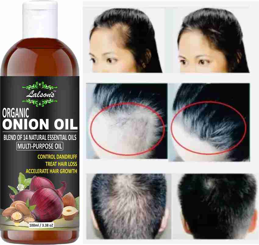 Best onion clearance oil for hair