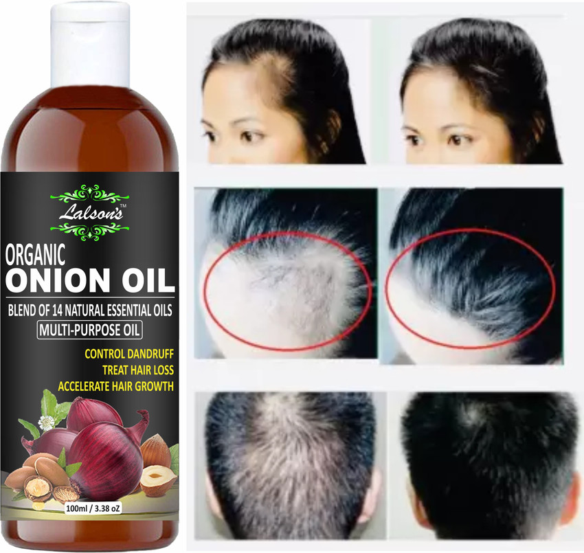 Onion oil for hair clearance growth