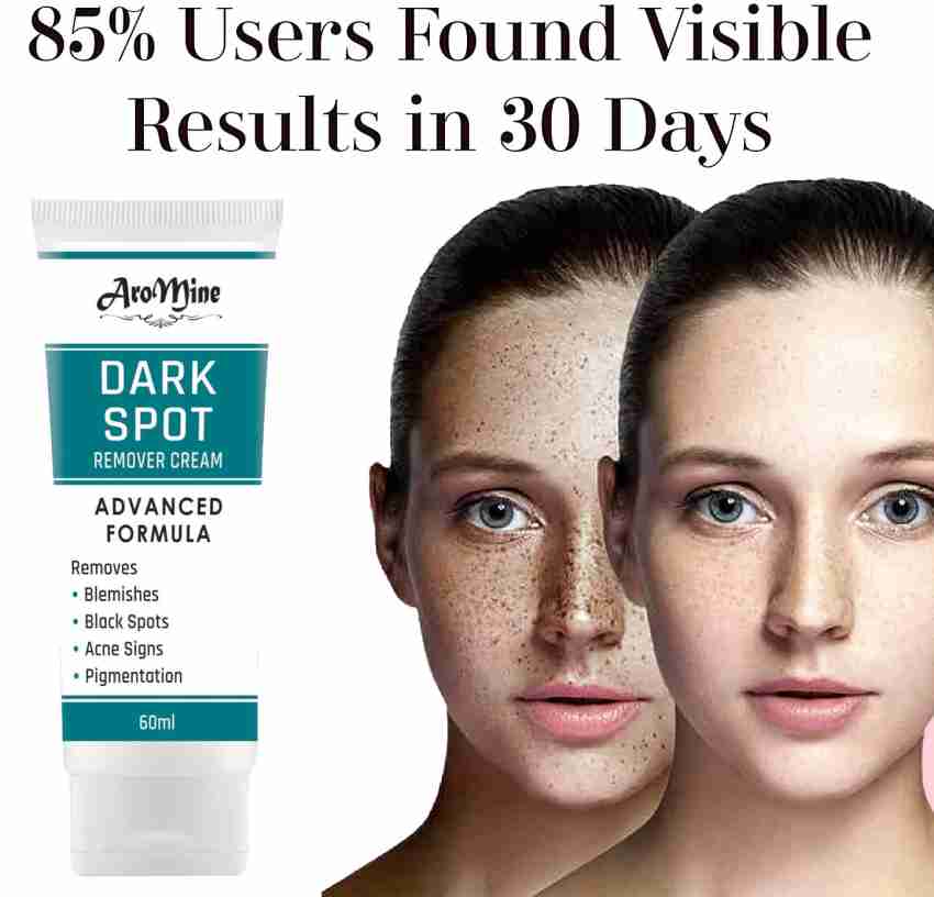 Pimple dark spots removal outlet cream