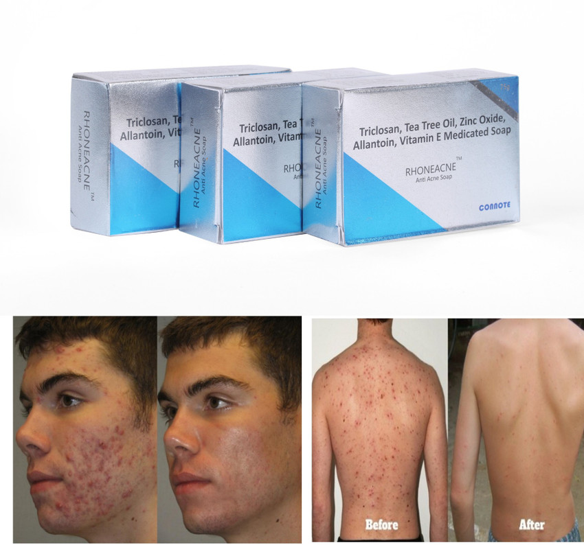 RHONEACNE Original Acne Pimple Fighting Soap For Oily to Normal