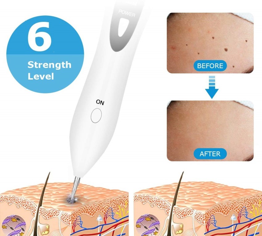 Plasma Pen Tattoo Removal: Can You Use Fibroblast Technology to Remove  Tattoos? – Dermavel