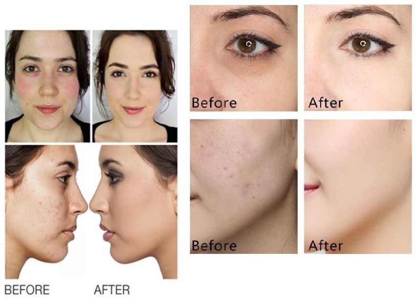 Face concealer dark clearance spots