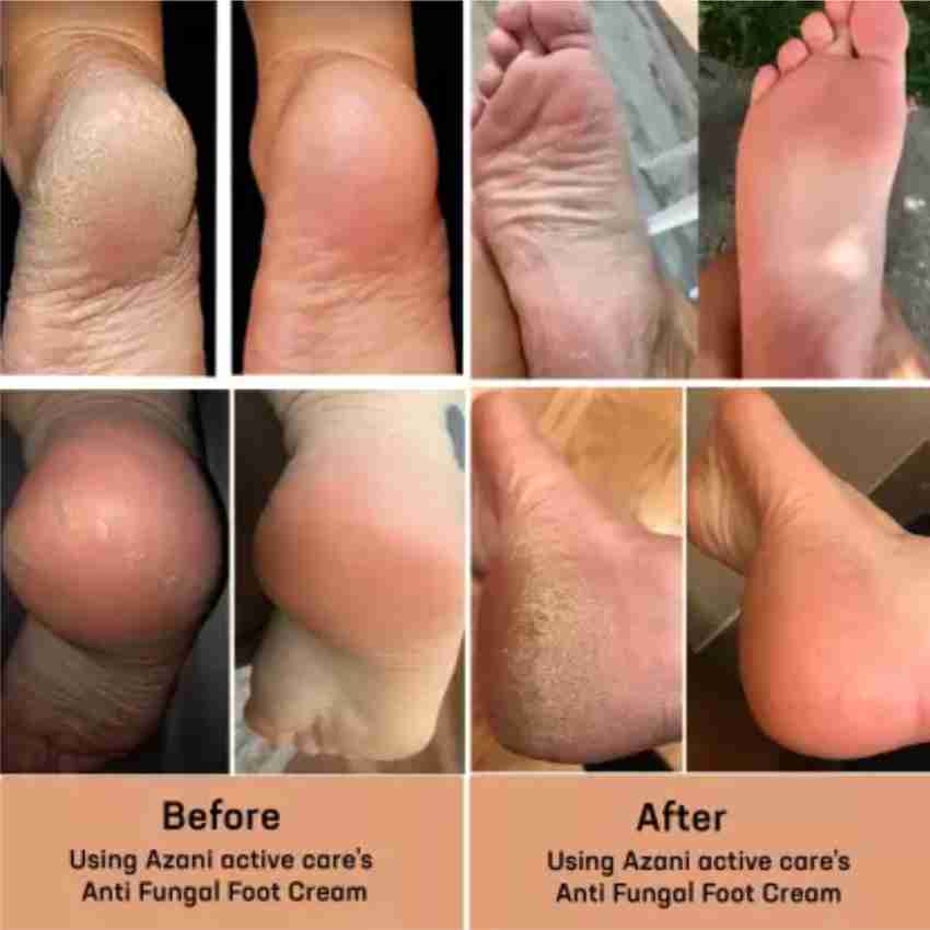 Antifungal cream for cracked heels new arrivals