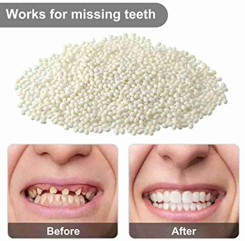 Calandis DIY Tooth Filling Thermal Beads Temporary Teeth Repair Moldable  Teeth Whitening Kit Price in India - Buy Calandis DIY Tooth Filling Thermal  Beads Temporary Teeth Repair Moldable Teeth Whitening Kit online