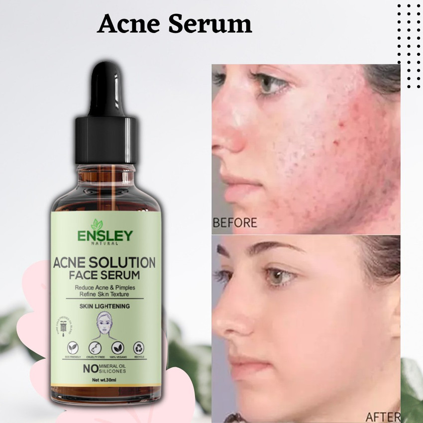 Acne solution outlet