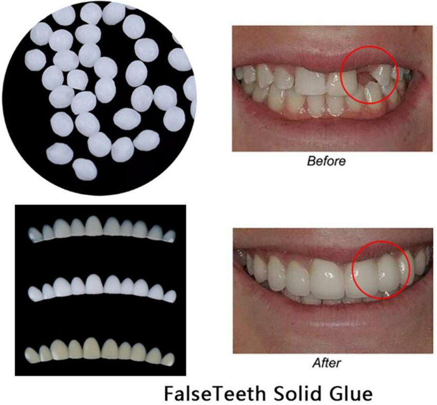 SILNOVO Moldable Teeth Veneers with Adhesive Fitting Beads