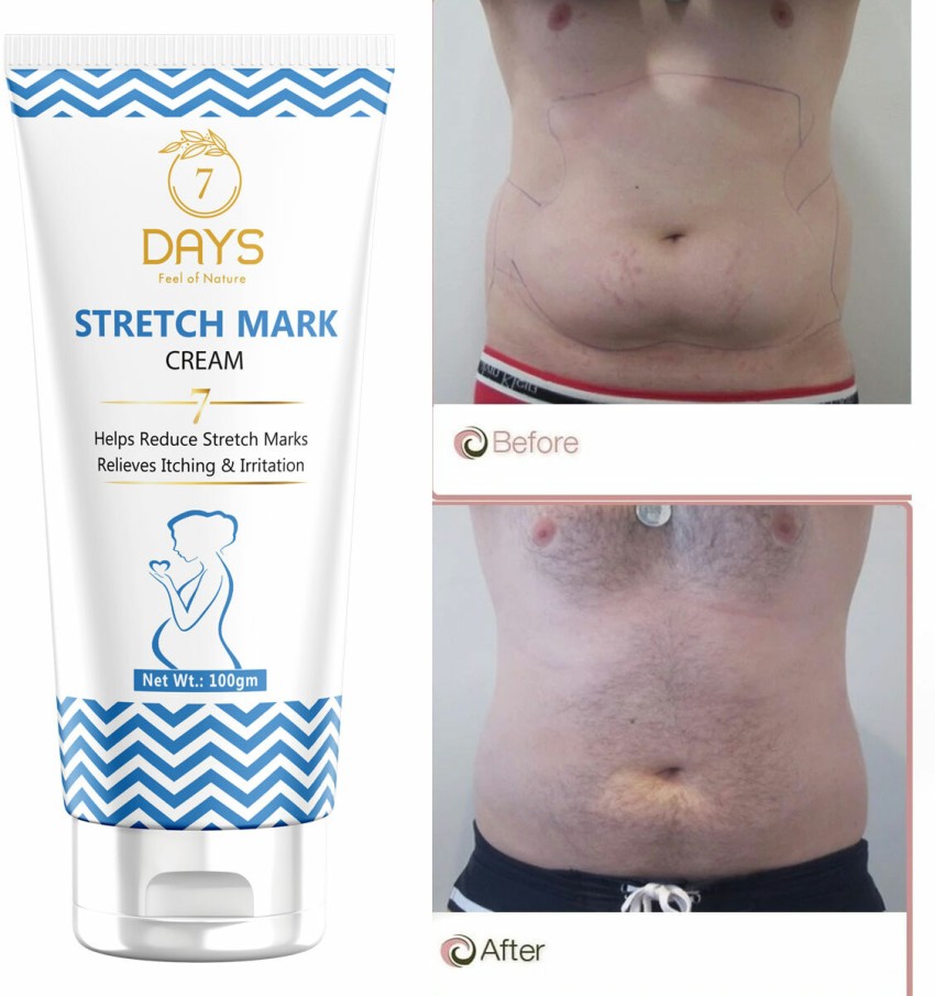after pregnancy stretch marks cream after pregnancy breast size increase at  Rs 3599/piece, Stretch Marks Removal Cream in Haridwar