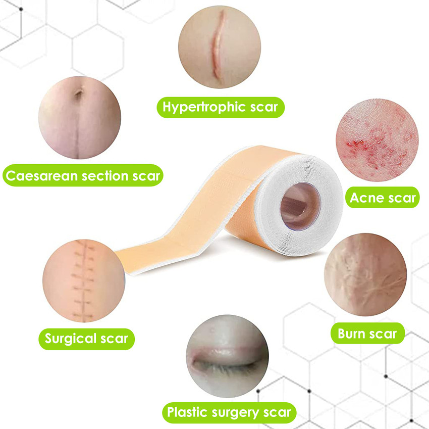 Silicone tape for outlet keloids