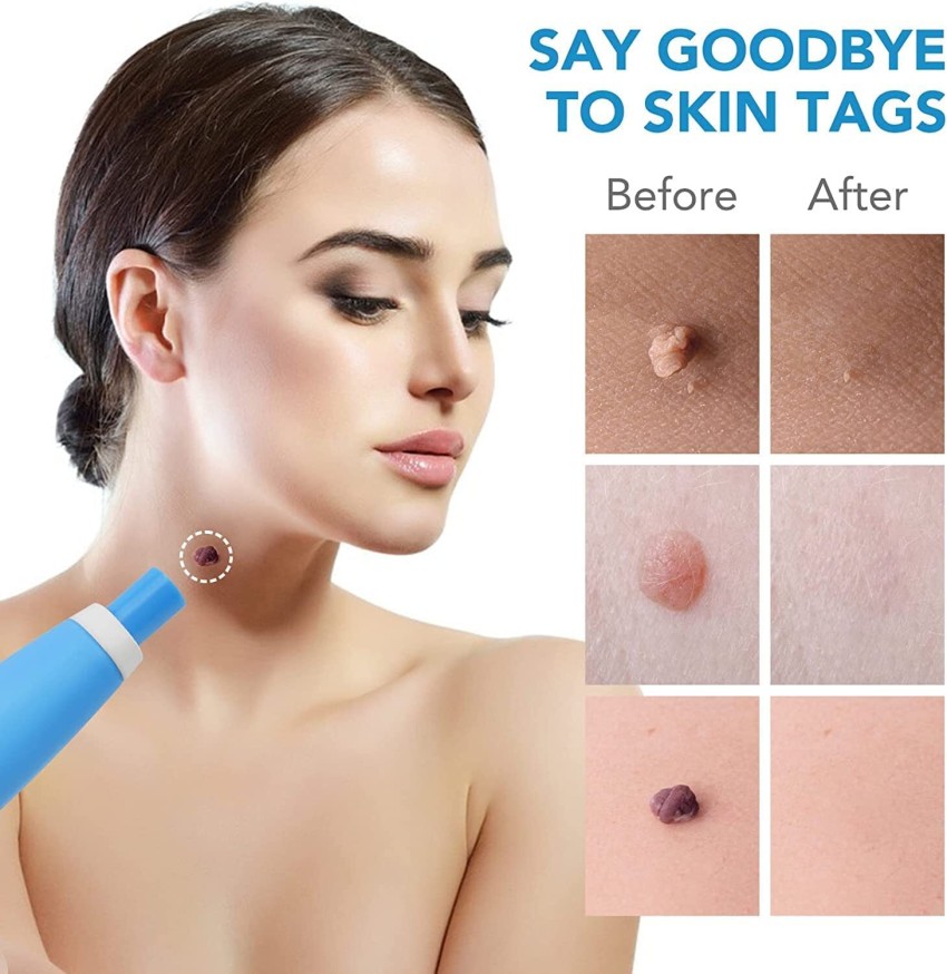 Skin Tag Remover Is a No. 1 Bestseller on