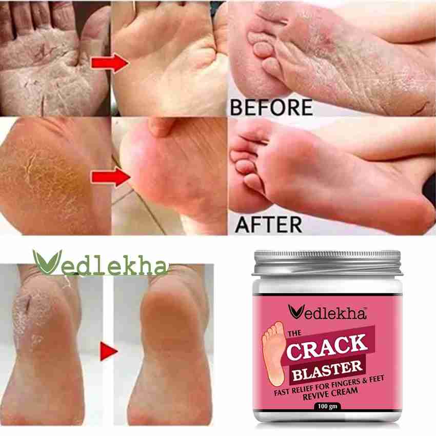 Milky foot cracked heels cheap
