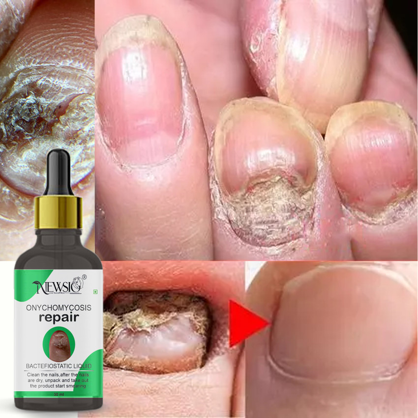 Fungus treatment discount
