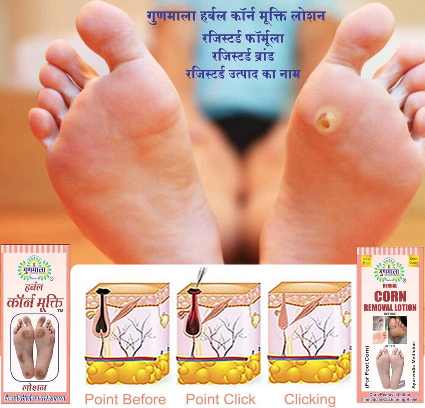 Ayurvedic treatment for outlet corns in foot