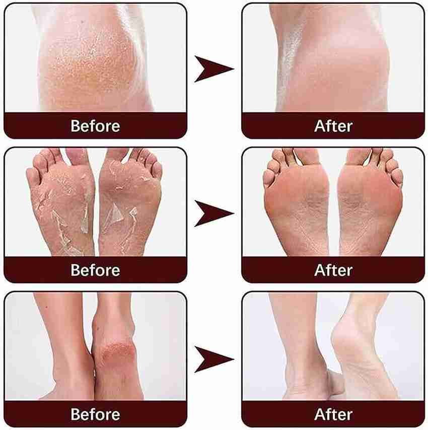 Dry cracked feet fungus home remedy store