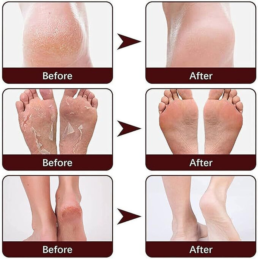Foot dry and cracked online
