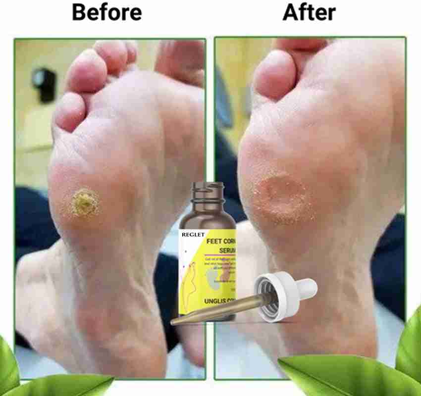 Corn on a toe treatments for removal store