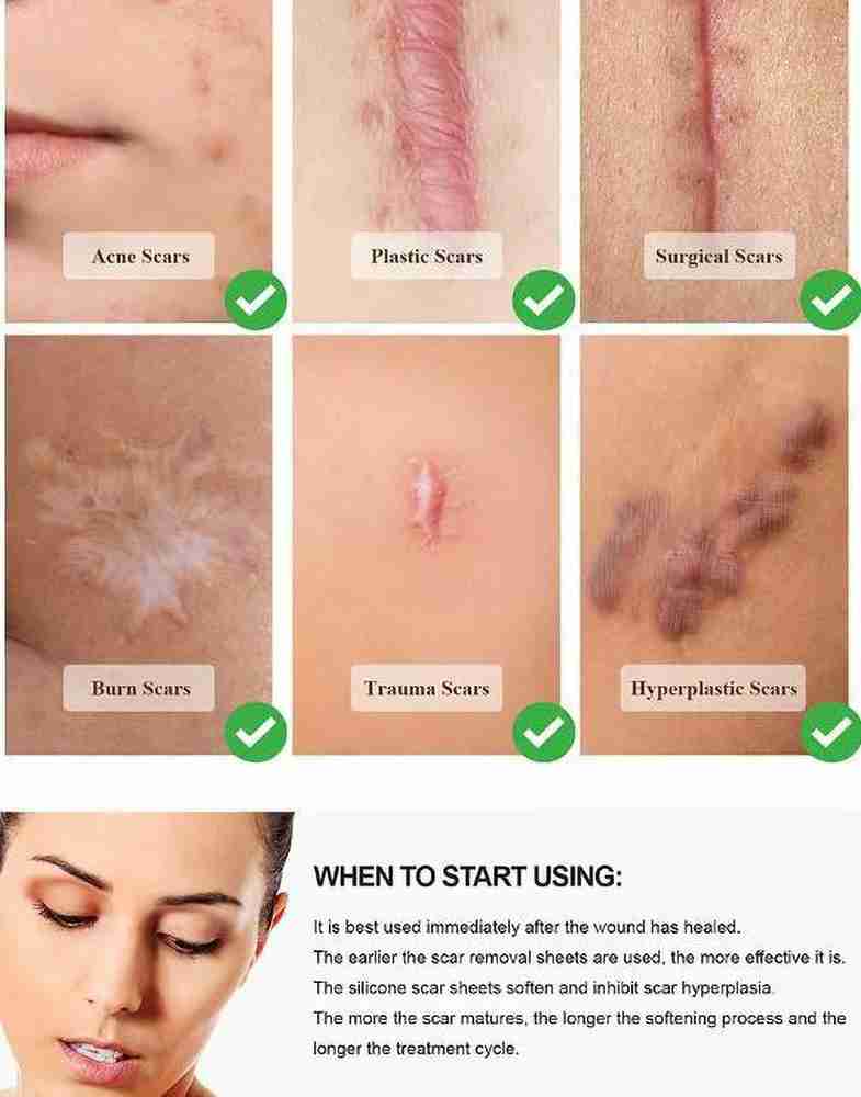 Eelhoe Silicone Scar Removal Sheets Acne Scars Silicon Soft Long scar removal Strips