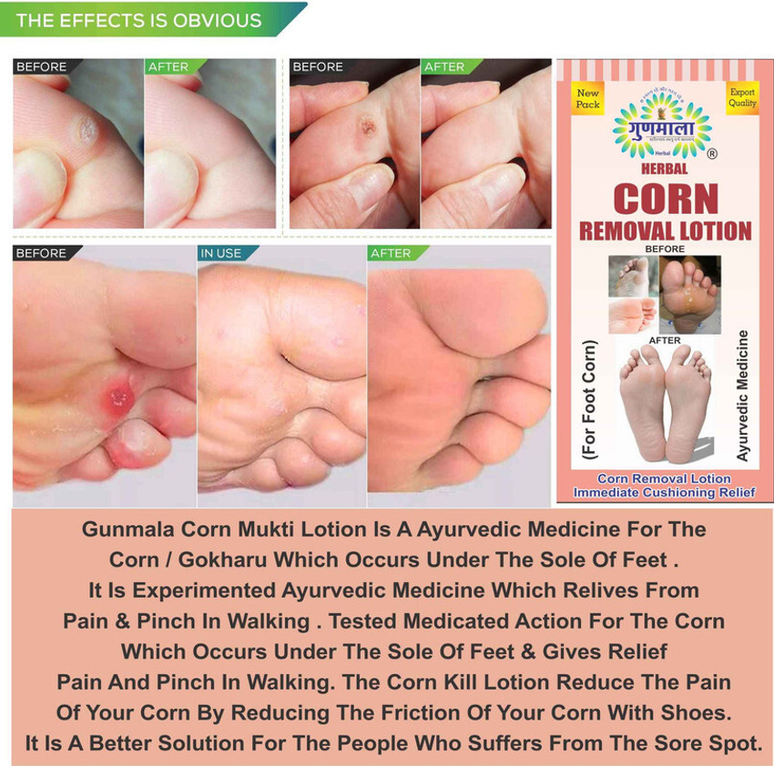 Gunmala Corn Mukti Ministry Of Ayush Approved Products Callus