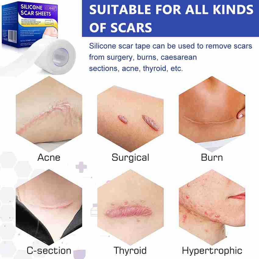 Where to buy silicone gel sheets 2024 for scars