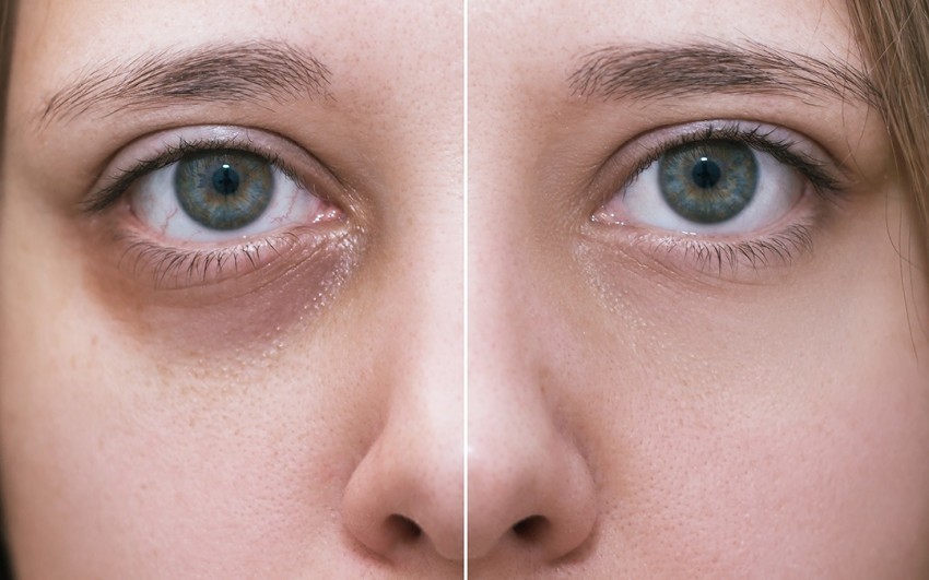 How to Get Rid of Bags Under Your Eyes | Johns Hopkins Medicine