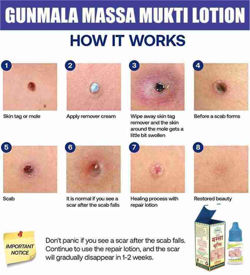 Gunmala Corn Removal Lotion, Foot / Finger / Hand / Feet Callus Remover  Paste - 5 Ml. Face Wash - Price in India, Buy Gunmala Corn Removal Lotion