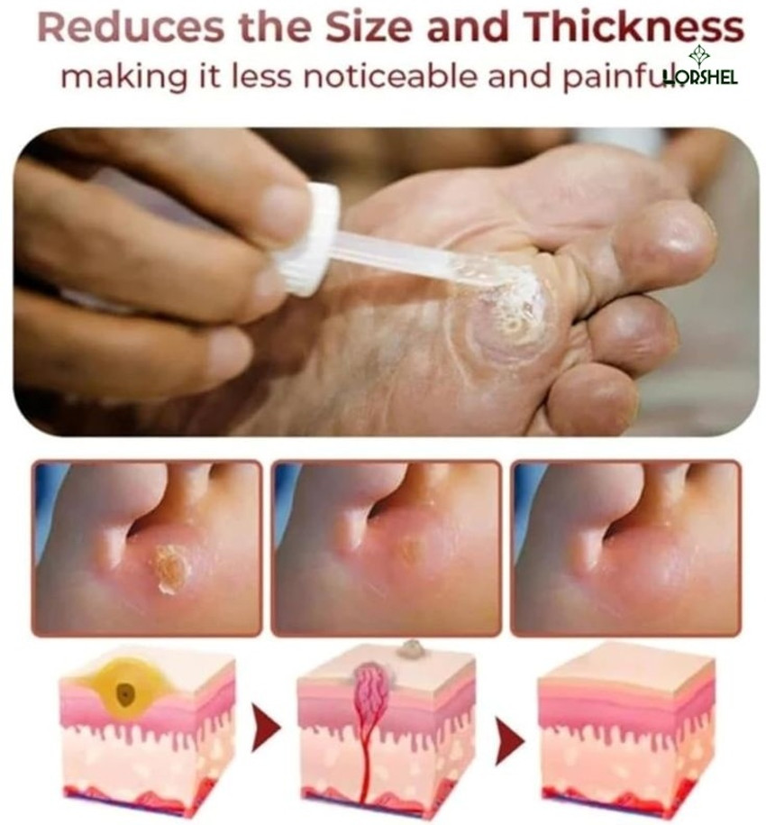 Remove corns naturally store