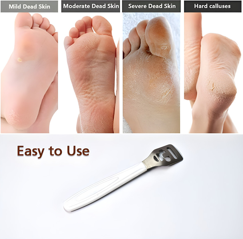 Hard skin on foot outlet heel