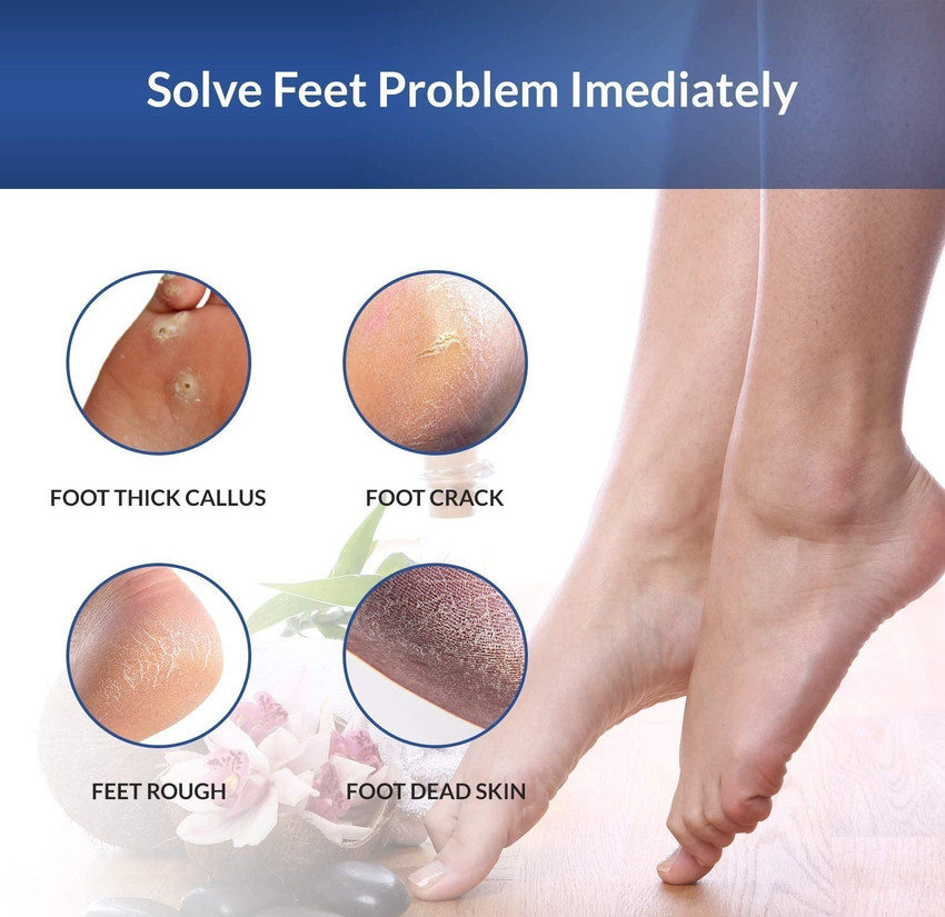WOONGMI Foot Callus Remover Pedi Roller Heel Dead Skin Crack Cleaner Price in India Buy WOONGMI Foot Callus Remover Pedi Roller Heel Dead Skin Crack Cleaner Online In India Reviews Ratings
