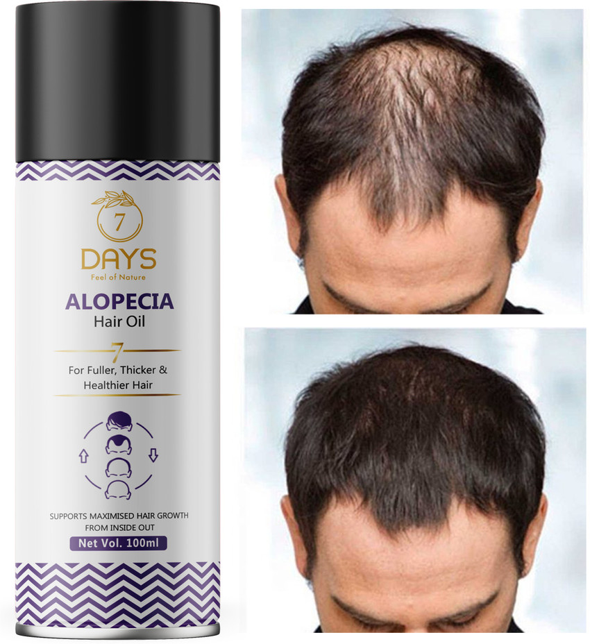 Details 125+ alopia hair oil ingredients super hot POPPY