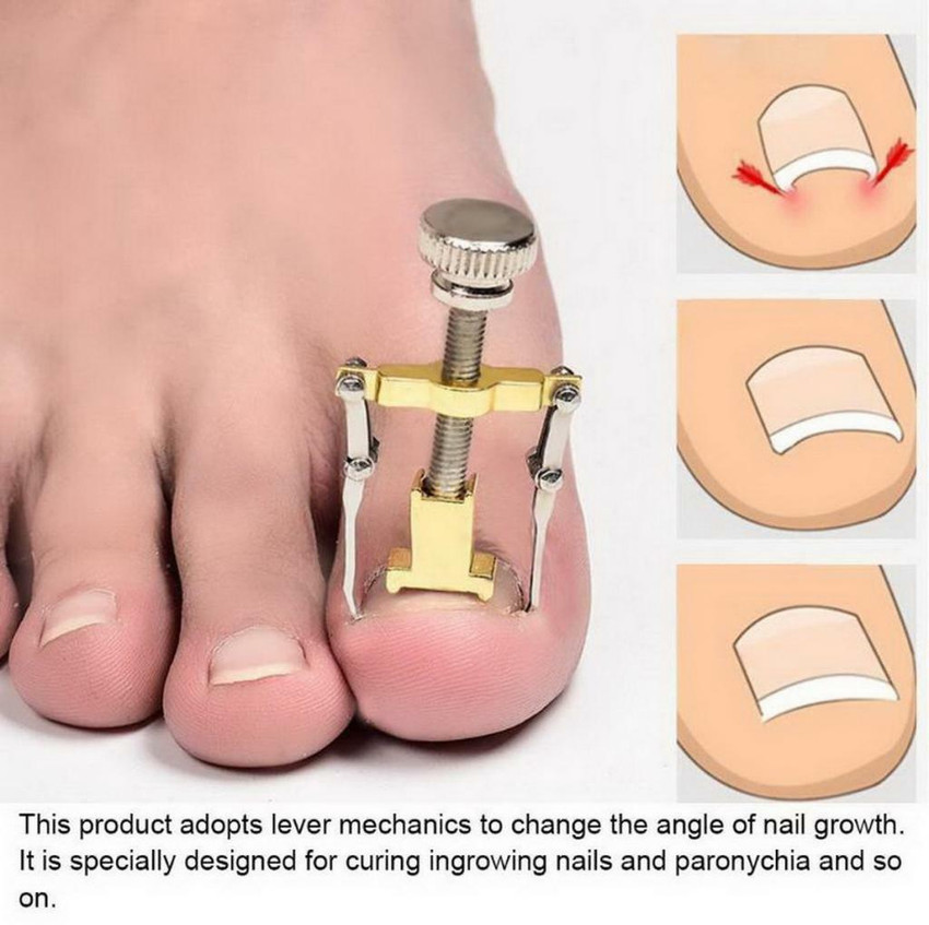 Ingrown toenail outlet from pedicure