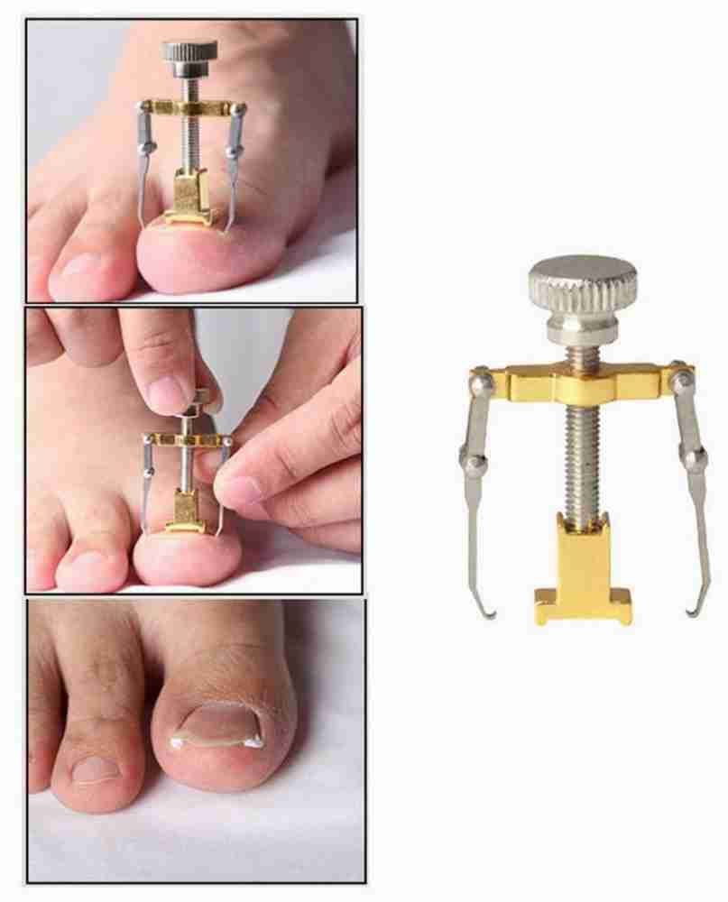 Ingrown toenail cheap from pedicure