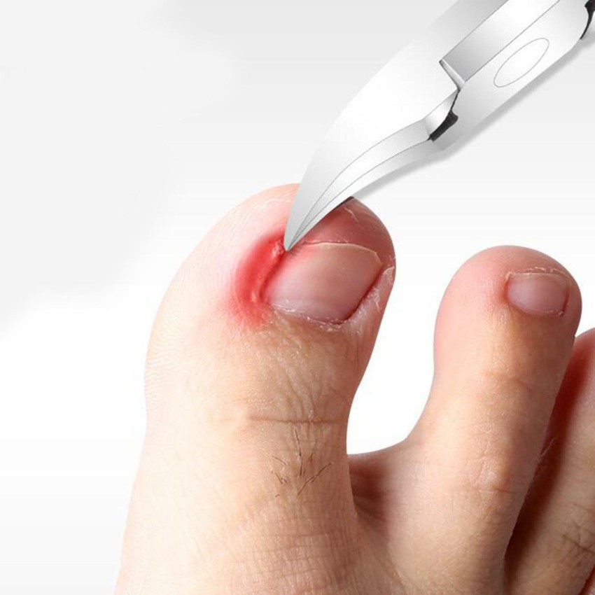 How to treat an ingrown toenail explained.