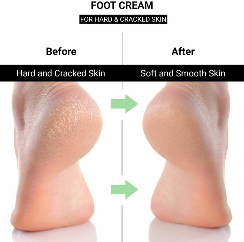 Rough hotsell cracked heels