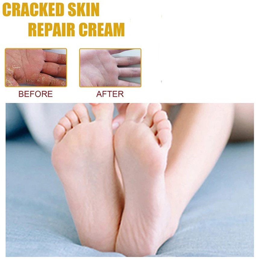 Heel skin repair store