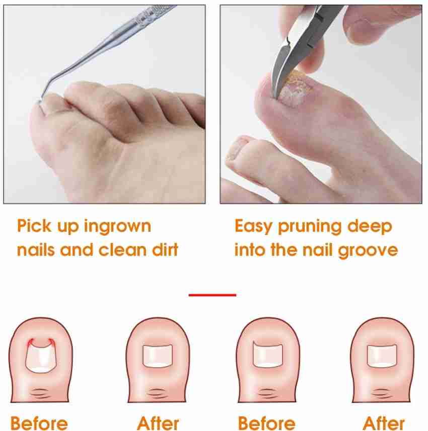 Moerae Toenail Toe Nail Clipper Cutter Thick Fungus Ingrown Scissors  Chiropody Podiatry - Price in India, Buy Moerae Toenail Toe Nail Clipper  Cutter Thick Fungus Ingrown Scissors Chiropody Podiatry Online In India