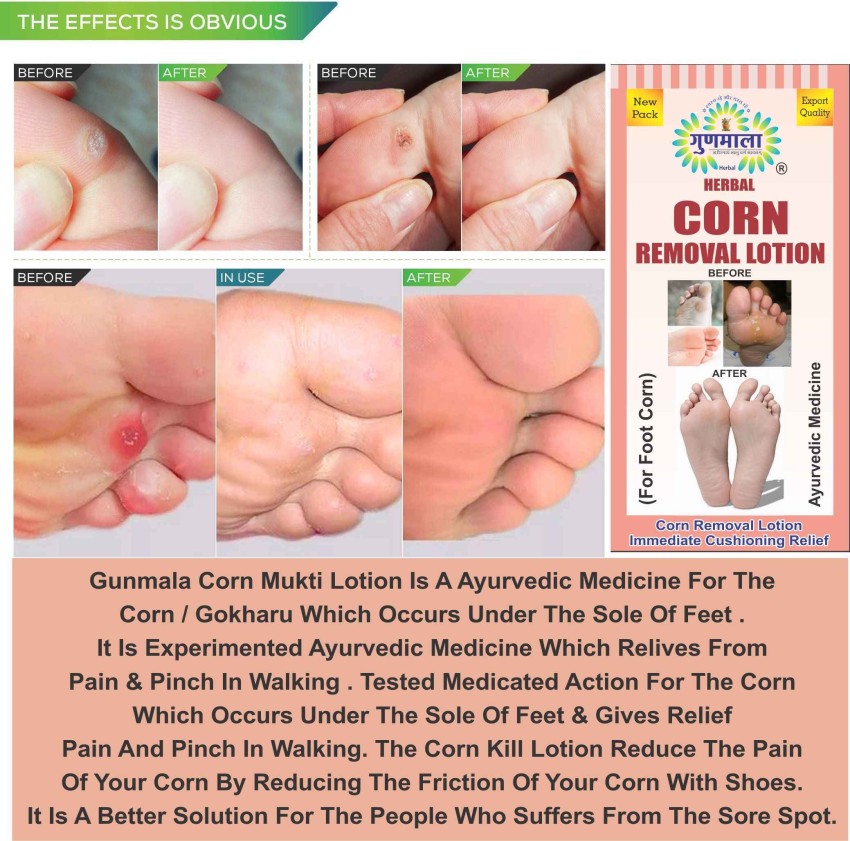 Gunmala foot corn remover liquid , for dry hard cracked heel skin repair /  swelling & pain relief / feet care men and women - Price in India, Buy  Gunmala foot corn