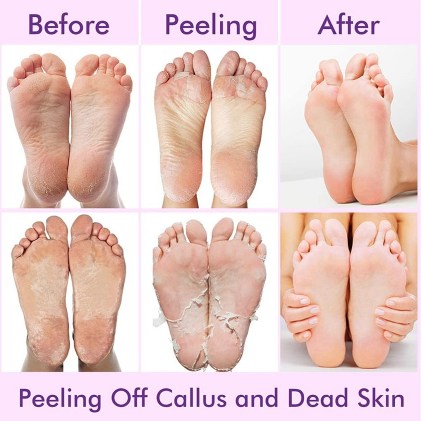 Skin on feet peeling and cracking new arrivals
