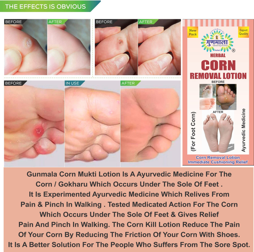 Gunmala Corn Removal Lotion For Dry Hard Foot Corns Repair swelling Pain Relief 15 Ml Price in India Buy Gunmala Corn Removal Lotion For Dry Hard Foot Corns Repair swelling Pain