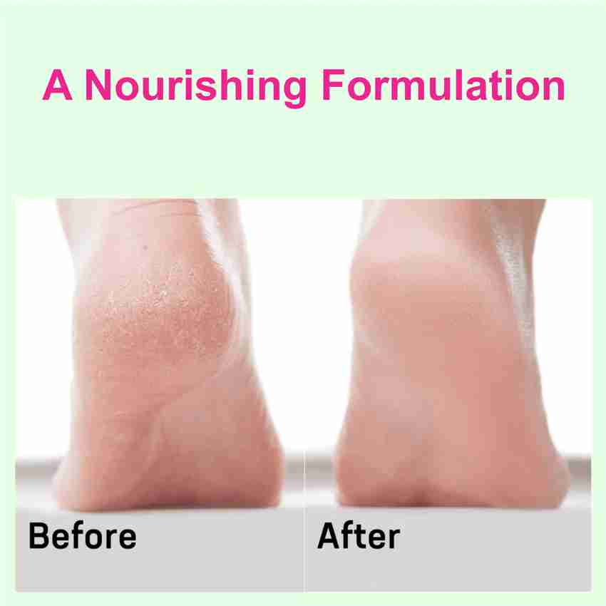 Dry cracked feet fungus top