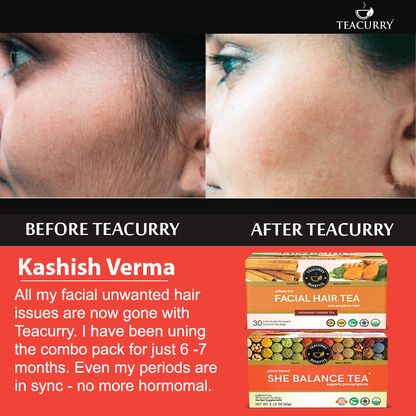 Update 135+ pcos facial hair removal best camera.edu.vn