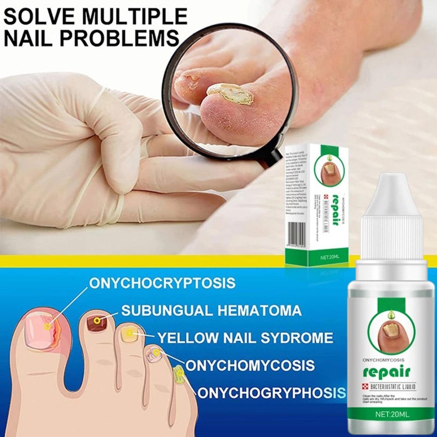 Better Nail - Treatment for Fungus Under & Around the Nail - Maximum  Strength 25% Solution for Nail Support - Walmart.com