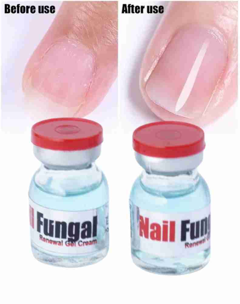 Nail fungal store cream