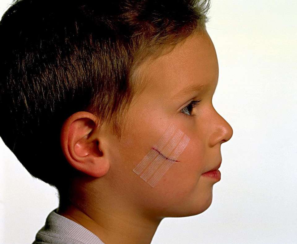 3M Nexcare Steri-Strip Skin Closure 1/4 X 4 Inches, 30 Count Adhesive ...