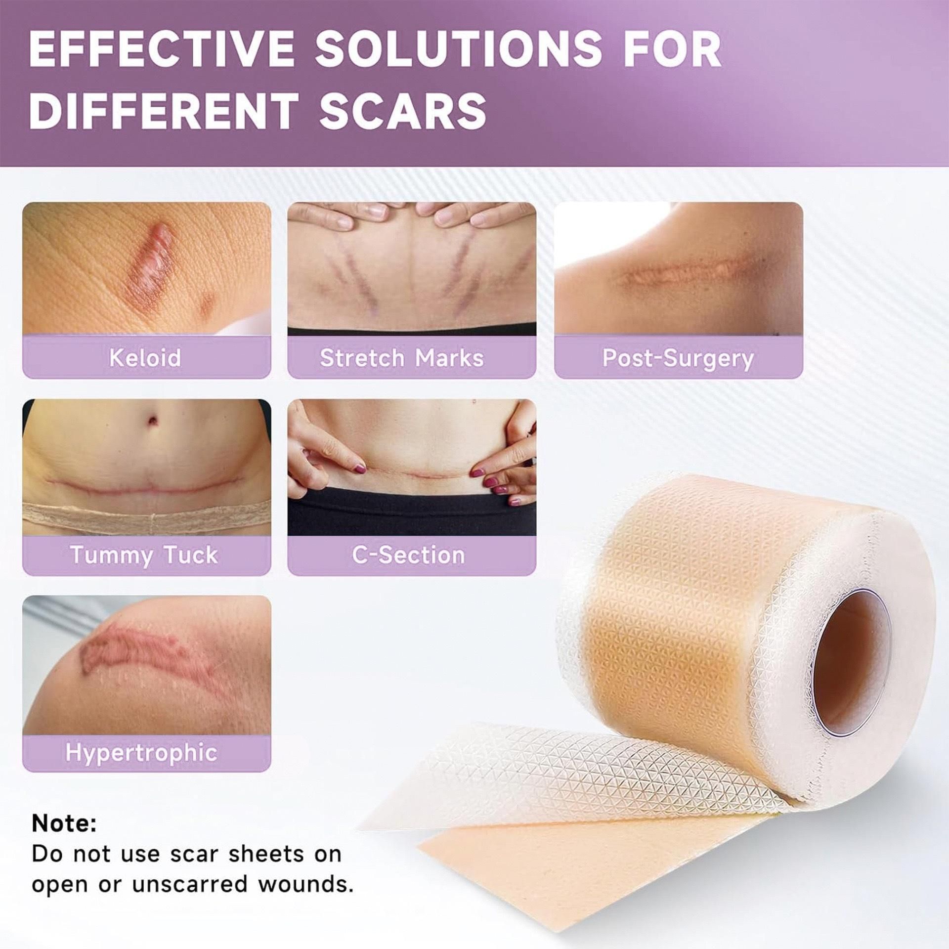 Acne C-section Scar Remover Silicone sheets Interactive scar removal tape Gauze Medical Dressing-image-20