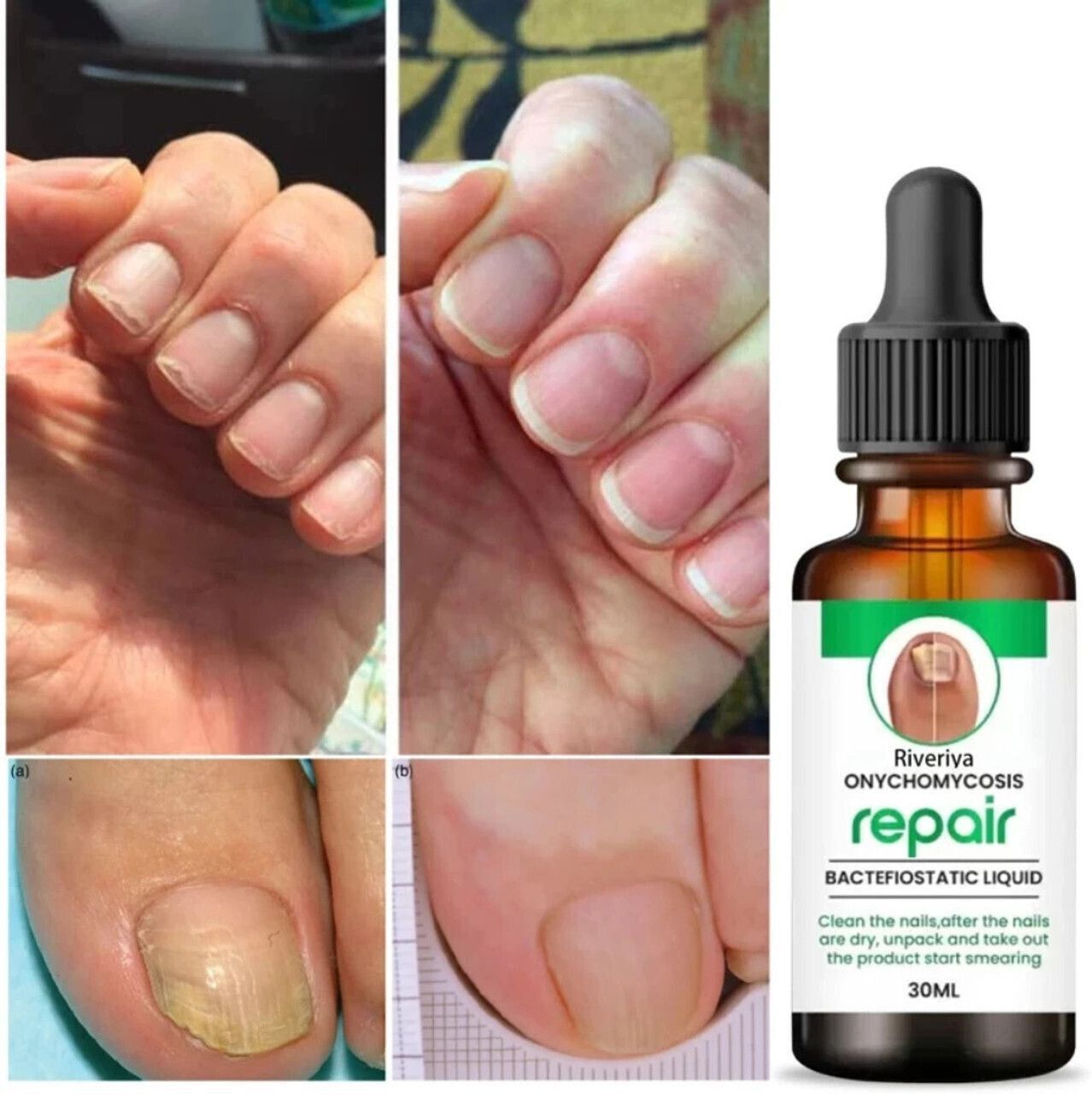 motyl Fungal Nail Treatment Liquid | Repair & Removal Solution for Nails (PACK OF 1) CLEAR-picture-13